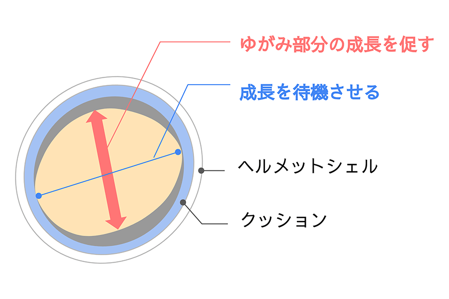 ヘルメット治療の原理